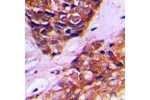Immunohistochemical analysis of PEX10 staining in human prostate cancer formalin fixed paraffin embedded tissue section. (PEX10 抗体)