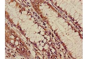 Immunohistochemistry of paraffin-embedded human colon cancer using ABIN7144542 at dilution of 1:100 (ALOX5 抗体  (AA 2-149))