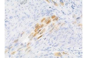 ABIN6256162 and ABIN6267639 at 1/100 staining human tongue carcinoma by IHC-P.