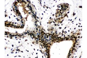 Visfatin was detected in paraffin-embedded sections of human mammary cancer tissues using rabbit anti- Visfatin Antigen Affinity purified polyclonal antibody (Catalog # ) at 1 µg/mL. (NAMPT 抗体  (AA 62-337))