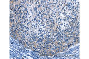 Immunohistochemistry of Human cervical cancer using IL2RB Polyclonal Antibody at dilution of 1:30 (IL2 Receptor beta 抗体)