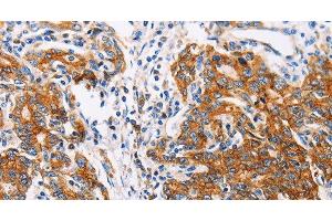 Immunohistochemistry of paraffin-embedded Human gastic cancer using CTNNA1 Polyclonal Antibody at dilution of 1:35 (CTNNA1 抗体)