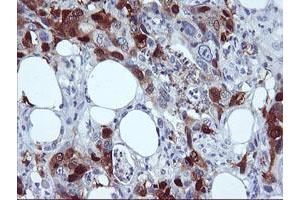 Immunohistochemical staining of paraffin-embedded Carcinoma of Human pancreas tissue using anti-SERPINB2 mouse monoclonal antibody. (SERPINB2 抗体)