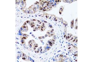 Immunohistochemistry of paraffin-embedded human gastric cancer using UHRF1 antibody. (UHRF1 抗体)