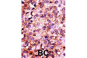 Formalin-fixed and paraffin-embedded human cancer tissue reacted with PANK3 polyclonal antibody  , which was peroxidase-conjugated to the secondary antibody, followed by AEC staining. (PANK3 抗体  (N-Term))