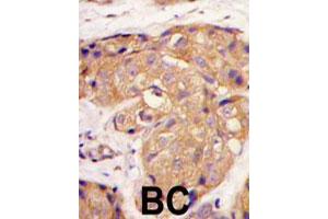 Formalin-fixed and paraffin-embedded human breast carcinoma tissue reacted with SOST polyclonal antibody  , which was peroxidase-conjugated to the secondary antibody, followed by DAB staining. (Sclerostin 抗体  (N-Term))