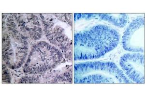 Immunohistochemical analysis of paraffin-embedded human colon carcinoma tissue, using IKKα (Ab-23) antibody (E021123). (IKK alpha 抗体)