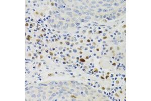 Immunohistochemistry of paraffin-embedded human lung cancer using GEMIN2 Antibody. (SIP1 抗体)