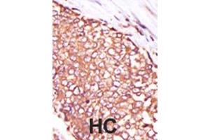Formalin-fixed and paraffin-embedded human cancer tissue reacted with the primary antibody, which was peroxidase-conjugated to the secondary antibody, followed by DAB staining. (PKC theta 抗体  (C-Term))