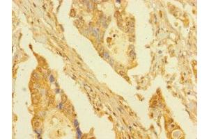 Immunohistochemistry of paraffin-embedded human pancreatic cancer using ABIN7165304 at dilution of 1:100 (DPY30 抗体  (AA 1-99))