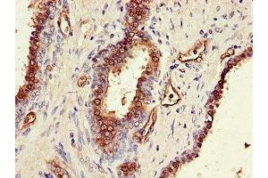 Immunohistochemistry of paraffin-embedded human prostate cancer using ABIN7170330 at dilution of 1:100 (SORD 抗体  (AA 201-357))