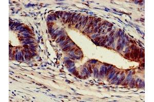 Immunohistochemistry of paraffin-embedded human colon cancer using ABIN7143447 at dilution of 1:100