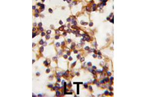 Formalin-fixed and paraffin-embedded human lymph tissue reacted with RICTOR polyclonal antibody  , which was peroxidase-conjugated to the secondary antibody, followed by DAB staining. (RICTOR 抗体  (N-Term))