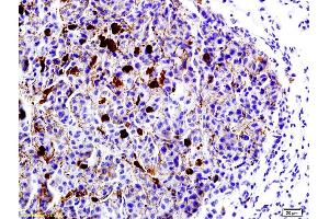 Formalin-fixed and paraffin embedded mouse lung cancer labeled with Anti-LRP1/CD91 Polyclonal Antibody, Unconjugated (ABIN748988) at 1:200 followed by conjugation to the secondary antibody and DAB staining (LRP1 抗体  (AA 4451-4545))