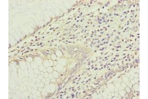 Immunohistochemistry of paraffin-embedded human colon cancer using ABIN7156905 at dilution of 1:100 (IL1F9 抗体  (AA 1-169))