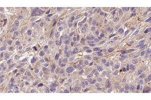 ABIN6272299 at 1/100 staining Human Melanoma tissue by IHC-P. (FGF22 抗体  (Internal Region))