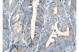 ABIN6268798 at 1/100 staining human Endometrial cancer tissue sections by IHC-P. (VEGFB 抗体  (Internal Region))