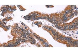 Immunohistochemistry of paraffin-embedded Human colon cancer using IRAK1BP1 Polyclonal Antibody at dilution of 1:40 (IRAK1BP1 抗体)