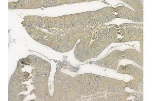 ABIN6258086 and ABIN6273824 at 1/100 staining human renal cell carcinoma by IHC-P. (CEACAM3 抗体  (Internal Region))