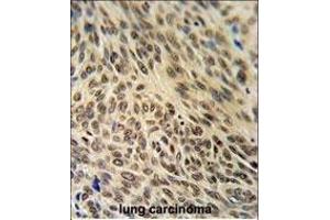 XRCC6 Antibody (C-term) (ABIN651280 and ABIN2840167) IHC analysis in formalin fixed and paraffin embedded human lung carcinoma followed by peroxidase conjugation of the secondary antibody and DAB staining.