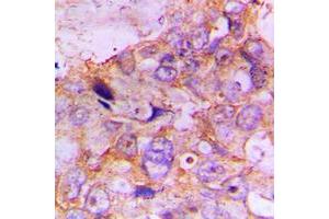 Immunohistochemical analysis of Caspase 7 staining in human lung cancer formalin fixed paraffin embedded tissue section.