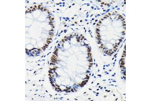 Immunohistochemistry of paraffin-embedded human colon using Phospho-Rb-S780 antibody (ABIN7269936) at dilution of 1:100 (40x lens). (Retinoblastoma 1 抗体  (pSer780))