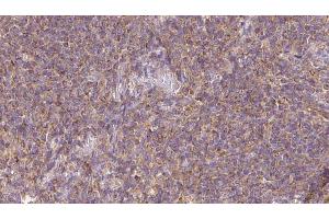ABIN6273154 at 1/100 staining Human lymph cancer tissue by IHC-P. (RASGRP3 抗体  (Internal Region))