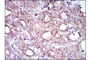 Immunohistochemical analysis of paraffin-embedded cervical cancer tissues using MRPL42 mouse mAb with DAB staining. (MRPL42 抗体  (AA 142-203))