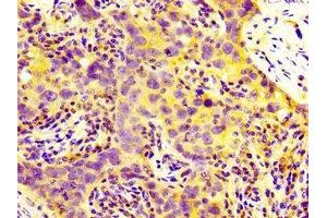 IHC image of ABIN7159247 diluted at 1:300 and staining in paraffin-embedded human pancreatic cancer performed on a Leica BondTM system. (MIA2 抗体  (AA 178-354))