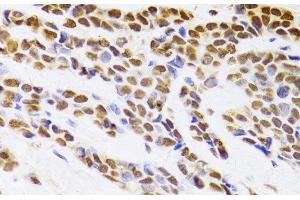 Immunohistochemistry of paraffin-embedded Human breast cancer using HDGF Polyclonal Antibody at dilution of 1:100 (40x lens). (HDGF 抗体)