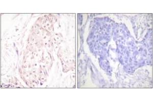 Immunohistochemistry analysis of paraffin-embedded human breast carcinoma tissue, using SENP8 Antibody. (SENP8 抗体  (AA 161-210))