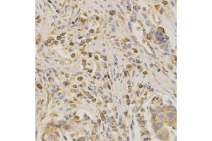 Immunohistochemistry of paraffin-embedded human stomach cancer using BAK1 antibody (ABIN6291815) at dilution of 1:200 (40x lens). (BAK1 抗体)