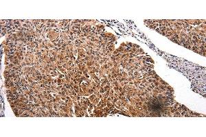 Immunohistochemistry of paraffin-embedded Human renal cancer tissue using RAB41 Polyclonal Antibody at dilution 1:100 (RAB41 抗体)