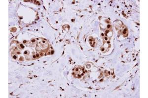 IHC-P Image ERH antibody detects ERH protein at cytosol on human breast cancer by immunohistochemical analysis. (ERH 抗体  (Center))