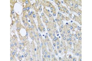 Immunohistochemistry of paraffin-embedded Human liver damage using UQCRC2 Polyclonal Antibody at dilution of 1:100 (40x lens). (UQCRC2 抗体)