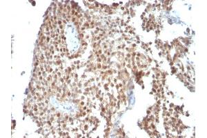 Formalin-fixed, paraffin-embedded human Bladder Carcinoma stained with p53 Monoclonal Antibody (SPM590) (p53 抗体)