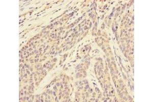 Immunohistochemistry of paraffin-embedded human ovarian cancer using ABIN7170628 at dilution of 1:100 (RBM17 抗体  (AA 1-240))