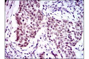 Immunohistochemical analysis of paraffin-embedded breast cancer tissues using FOXP1 mouse mAb with DAB staining. (FOXP1 抗体  (AA 481-677))