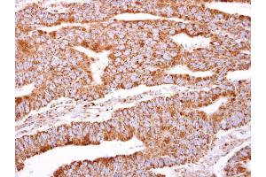 IHC-P Image PACSIN2 antibody [N2C3] detects PACSIN2 protein at cytosol on human colon carcinoma by immunohistochemical analysis.