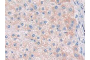 DAB staining on IHC-P; Samples: Human Liver cancer Tissue (RNASE8 抗体  (AA 19-154))