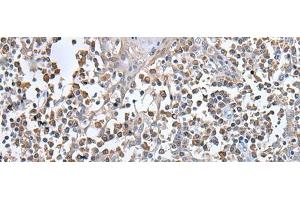 Immunohistochemistry of paraffin-embedded Human tonsil tissue using UBN1 Polyclonal Antibody at dilution of 1:130(x200) (Ubinuclein 1 抗体)