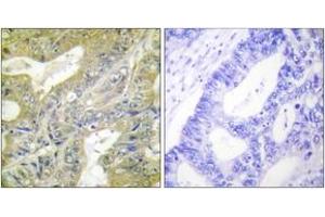 Immunohistochemistry analysis of paraffin-embedded human colon carcinoma tissue, using HEXB Antibody. (HEXB 抗体  (AA 481-530))