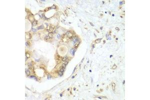 Immunohistochemistry of paraffin-embedded human liver cancer using VTI1B antibody (ABIN6132781, ABIN6150162, ABIN6150163 and ABIN6222854) at dilution of 1:100 (40x lens).