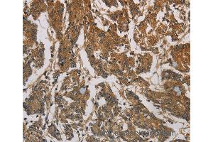 Immunohistochemistry of Human colon cancer using CORO1C Polyclonal Antibody at dilution of 1:60