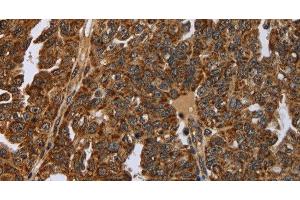 Immunohistochemistry of paraffin-embedded Human ovarian cancer tissue using NEFH Polyclonal Antibody at dilution 1:40 (NEFH 抗体)