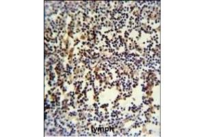 ANR49 Antibody (Center) (ABIN651157 and ABIN2840103) IHC analysis in formalin fixed and paraffin embedded human lymph carcinoma followed by peroxidase conjugation of the secondary antibody and DAB staining. (ANKRD49 抗体  (AA 80-109))