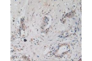 Detection of AREG in Human Pancreas Cancer Tissue using Monoclonal Antibody to Amphiregulin (AREG) (Amphiregulin 抗体  (AA 20-100))