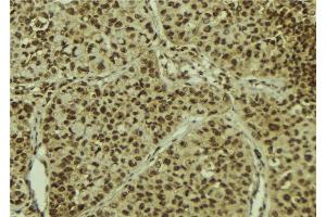 ABIN6278395 at 1/100 staining Human breast cancer tissue by IHC-P. (MGEA5 抗体)