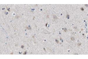 ABIN6279818 at 1/100 staining Human brain cancer tissue by IHC-P. (SH3GL3 抗体  (Internal Region))