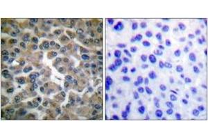 Immunohistochemistry analysis of paraffin-embedded human breast carcinoma tissue, using IkappaB-epsilon (Ab-22) Antibody. (IkappaB-epsilon 抗体  (AA 131-180))
